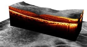 3D prikaz makule na OCT A makula 3 dimenziós OCT felvétele