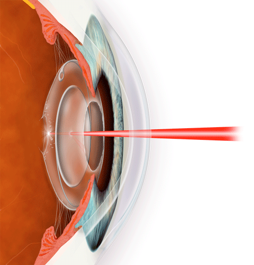 Yag laser kapsulotomija Yag lézer - kapszulotómia