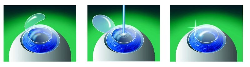 Lasersko uklanjanje dioptrije Lasersko skidanje dioptrije