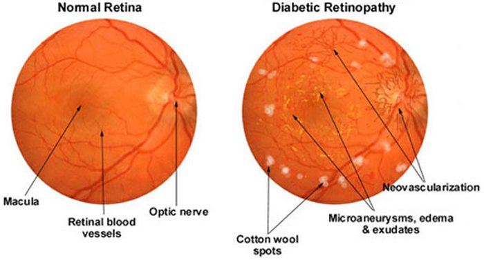 Zdrava retina i dijabetična retinopatija Zdrava retina i dijabetična retinopatija