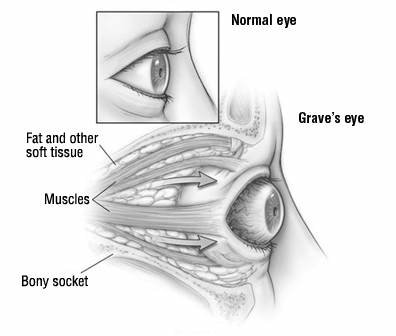 Tireoidna oftalmopatija Tireoidna oftalmopatija