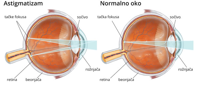 Astigmatizam Astigmatizam