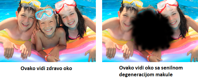 Vid sa senilnom degeneracijom makule Vid sa senilnom degeneracijom makule