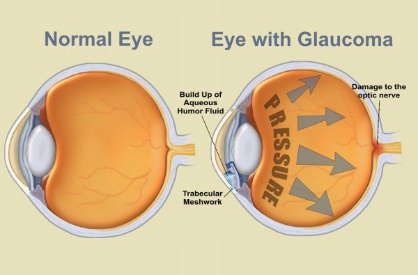 glaucoma1-e1364063038132